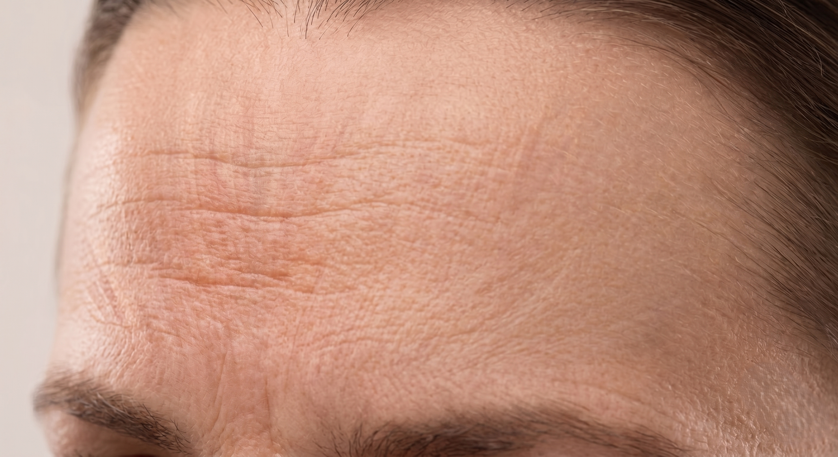 Forehead Lines